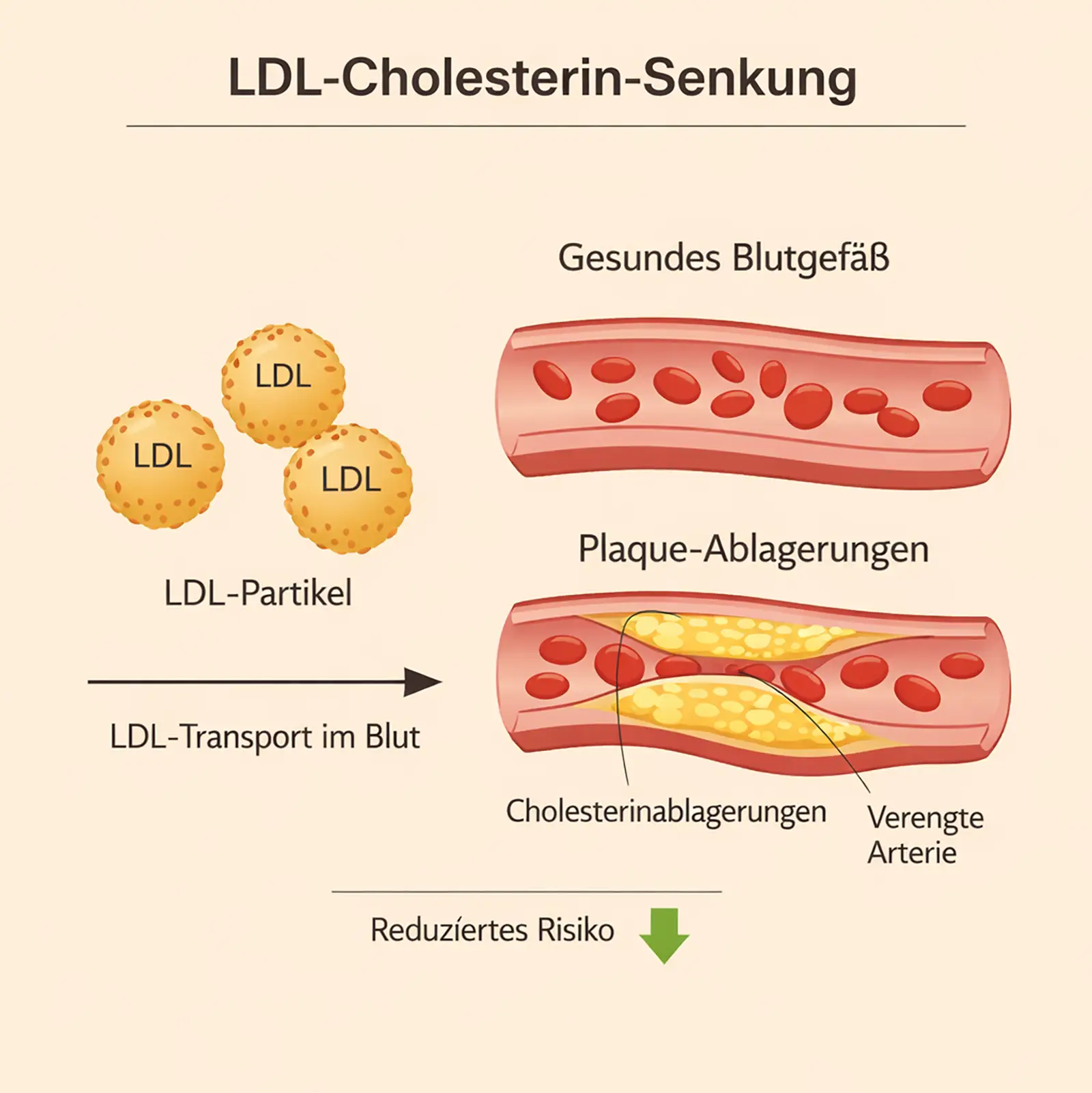 Diagramm zur LDL-Cholesterin-Senkung mit Darstellung von LDL-Partikeln und möglichen Gefäßablagerungen