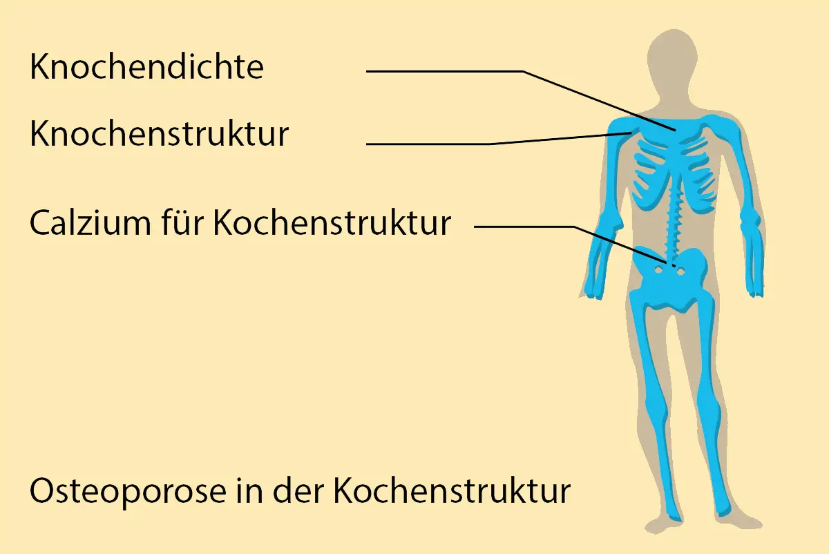 Osteoporose in der Knochenstruktur